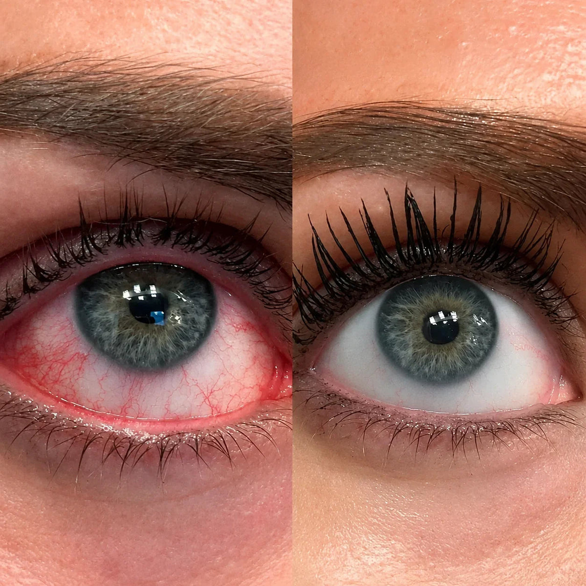 Rood, geirriteerd oog naast een helder oog